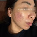 기쁨한의원 | [천안/신부동] **한의원 새살침으로 얻은 여드름 패인...기회! 주변에서 난리난 2차 새살침 치료 후기:D