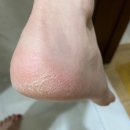발뒤꿈치각질제거 앙쥬앙 굳은살제거