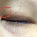 리멤버피부과의원 | 비립종, 한관종 제거 위한 정보 서치 - 2동탄 피부과 / 에스테틱 (레이크봄봄,리멤버/아루아 에스테틱)