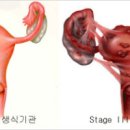 자궁질환 자궁내막증 증상 및 원인, 수술 (임신, 생리통, 성교통증장애) 이미지