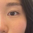 미라네집 | 강남역피부과 판다존주사 눈밑콜라겐주사 미라콜 후기