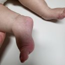스누피부과의원 | 10개월 아기 원인모를 발진/ 수족구 의심/ 복용약/ 아기 두드러기