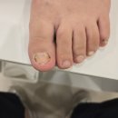 광교이엠365의원 | 광교 발톱무좀 수유 중에도 제대로 케어받았던 광교이엠365의원