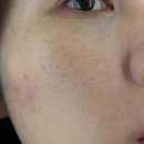 루카스병원 | 강남 논현피부과 잡티제거 여드름색소제거 클라리티 루카스토닝 후기