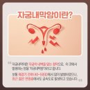20~30대에서 급증 '자궁 내막암 이미지