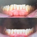 첨단예본치과의원 | 강남역치과 뉴엔치과 밝고 고른 치아 만들어주는 퍼스널라미 찐후기