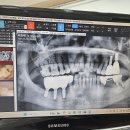 임플란트 시술 후기 이미지