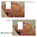 GS25 칠곡동천점 | 동천역 칠곡피부관리실, 대구에서 유일한 3V윤곽관리 '렛미인 에스테틱' 다녀왔어요 !