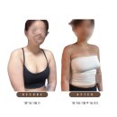 [내 돈 내산] 압구정탑라인의원 성형 후기 지방 흡입 2주 차 통증, 흉터/ 부작용 지방 흡입 고민인 사람...