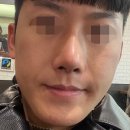 👀💫 교정된 눈매 + 오똑한 코라인! 안검하수(눈매교정) &amp; 코성형