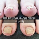 문제성 손발톱 전문관리 케어톱톱