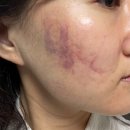 푸른신호약국 | 인모드 후 얼굴 멍 빼기 약국 멍크림 추천