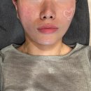 오르세윤의원 | [청담동 피부과] 처짐 예방! 리프팅은 축적! 리프테라 받고 얼굴 선 찾은 후기🤓