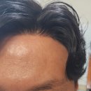 (주)이든파마 | 하이모 부분가발 사용하다 플러스에 오신분 시술후기를 올려봅니다