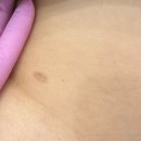 11620-전1-52-9 | [원톤스킨 스킨52] 특허 기기로 피부톤 맞추는 전문적인 흉터 커버 후기