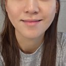 (주)점진 | 과천피부과 인모드후기 인모드포르마 얼마나 효과있을까?