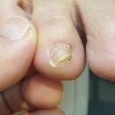 샵 손톱에물들다&페디클린업 | 문제성 발톱관리 경산 손톱에물들다 페디엔클린업