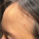 정은 에스테틱 | 화농성 여드름 피부과 약 복용 및 에스테틱 경과 후기