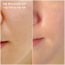 리뉴프렌즈 | 홍대입구역피부과 추천 비올 셀리뉴리프팅 600샷 효과 찐후기