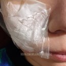 고고한의원 | 상계동한의원 얼굴흉터치료 새살침 후기 4회차