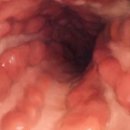 민들레양계장 | 아직까지 어떤 의학도 완치시킬 수 없다는 크론씨병(크론병)을 인산의학으로 치유한 사례