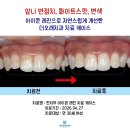 테크노수플란트치과의원 | 관평동치과 :: 앞니 얼룩제거, 반점치 치료, 변색치아 치료케이스