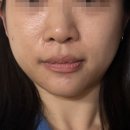 라임덴탈 | 영등포피부과 울쎄라피프라임 300샷 + 쥬베룩볼륨 6cc 당일 후기