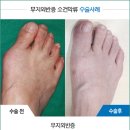 신발이며 깔창을 바꿔봐도 소용없어 무지외반증수술비용 알아보게되요 이미지