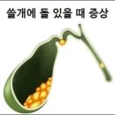쓸개에 돌 있을 때 나타나는 증상 이미지