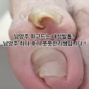 늘을2로26 | 남양주 파고드는 내성발톱 케어는 남양주 최다후기 보유한 풋풋한리쌤에서 관리 받으세요!