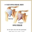 어깨 오십견의 진단과 치료 이미지