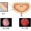 방광염 방광염 하복부통증 방광염 주요 신경성 방광 간질성 방광 이미지