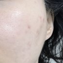 이룸 | 여드름 피부로 고민하다가 다녀온 이룸 에스테틱 후기 (효과 위주)