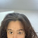 허리디스크수술 내시경 추간판 절제술 후기 (찐 내돈내산)