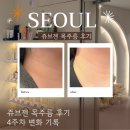 쥬브젠 목주름 후기, 효과 궁금해서 받아본 자가진피재생술(통증/회복과정/일상생활)