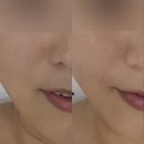 씨유 사천사남두인점 | 사천피부관리 맛집 에비뉴 에스테틱 | 작은얼굴 윤곽관리 + 물방울리프팅 받고 팔자볼륨 살아난 후기
