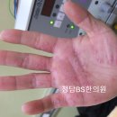 손발바닥의 작은 농포들, 피부탈락. 수장족저농포증. 특발성 건선