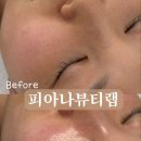 피아나뷰티랩 슈퍼젝션 블루 관리 후기💙