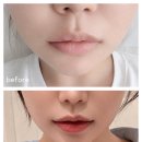 프라임 | 압구정피부과 울쎄라프라임 내돈내산 후기