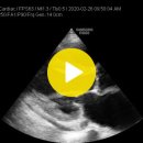 pericardial effusion (심낭 삼출) 이미지