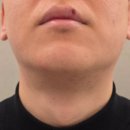 케어프러스 | 성수피부과 레이저제모 젠틀맥스프로플러스 수염 17회차