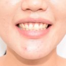 스마일클리어교정치과기공소 | 서울 턱관절 치과 1년 9개월 대장정 끝! (과개교합 교정 전후)