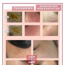 콜드플라즈마 이미지