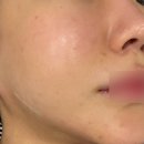 리쥬란 효과 4cc 통증 가격 주기 엠보 강남역성형외과 후기