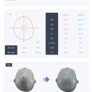 더존에이스 | 아기 사두교정 두상교정 헬멧 비바3D헬멧 2개월차 Before & Afrer