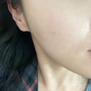 닥터케빈의원 | 강남축소잘하는병원 닥터케빈의원 비수술 얼굴축소 1회차 후기