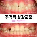 올바른치과기공소 | 예뻐지는 주걱턱 성장교정 동대문구 소아 교정 치료 후기