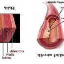 동맥경화증 이미지