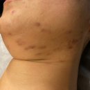 리치하임 2차 | 포항 여드름 여드름흉터 이거 모르면 좋아질 수 없다