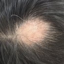 에스에이피부과의원 | SA 피부과] 👩🏻‍🦰 30대 여성 '가르마 탈모' 솔직 후기: 1년 관리 후 SA피부과에서 모량 회복한 비결 (feat...